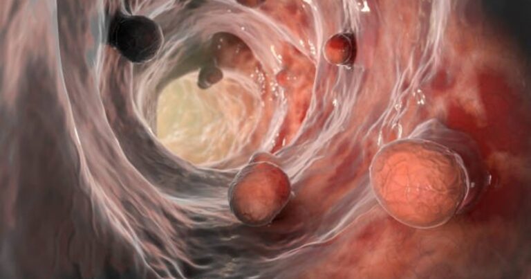 Harán un test muy sencillo en puestos callejeros para prevenir el segundo cáncer más frecuente